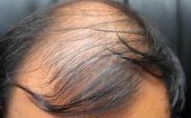 頭發一掉一大把 治療男性脫發的9個偏方