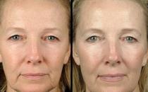 細數電波拉皮除皺的優勢