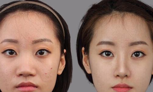 鼻翼整形術前6大禁忌 不可忽視