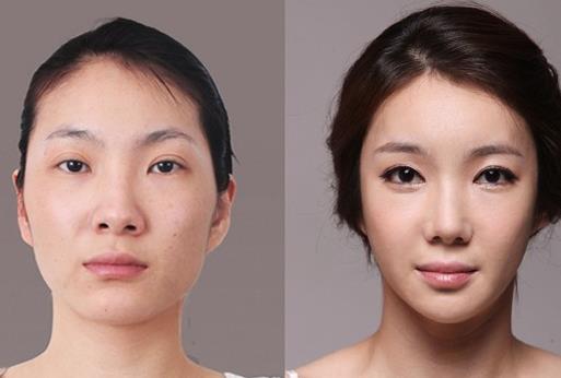 顴骨整形手術有什么優(yōu)勢呢