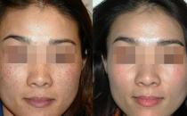 激光祛斑好不好 5大優(yōu)勢細細數(shù)