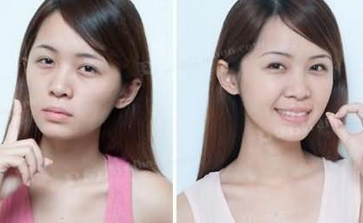 自體脂肪墊下巴術(shù)后如何護理?