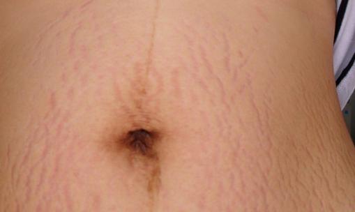 產(chǎn)后如何去除腹部妊娠紋