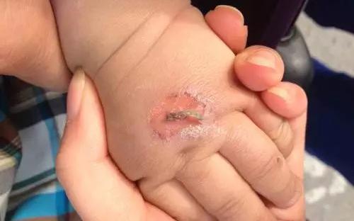 孩子常見的意外損傷類型有哪些?