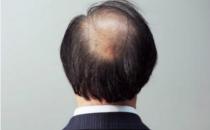 男人為什么更容易掉頭發