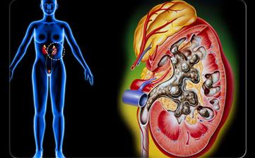 【腎結石】腎結石是怎么形成的_腎結石癥狀_腎結石治療方法_腎結石偏方 【腎結石】腎結石是怎么形成的_腎結石癥狀_腎結石治療方法_腎結石偏方