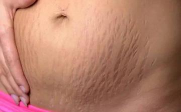 【妊娠紋】怎樣去妊娠紋小竅門_孕婦妊娠紋圖片_有什么辦法去掉妊娠紋 【妊娠紋】怎樣去妊娠紋小竅門_孕婦妊娠紋圖片_有什么辦法去掉妊娠紋