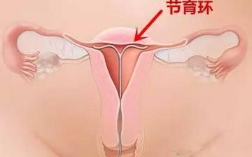 【節(jié)育環(huán)】節(jié)育環(huán)何時取出_帶哪種節(jié)育環(huán)好_取避孕環(huán)需要多少錢_上節(jié)育環(huán)后吃什么 【節(jié)育環(huán)】節(jié)育環(huán)何時取出_帶哪種節(jié)育環(huán)好_取避孕環(huán)需要多少錢_上節(jié)育環(huán)后吃什么
