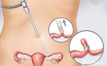 【女性結(jié)扎】女性結(jié)扎手術(shù)_結(jié)扎手術(shù)對女性的影響_女性結(jié)扎注意什么