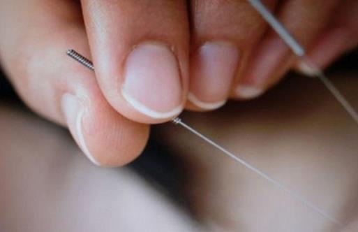 針灸美容到底可靠嗎?
