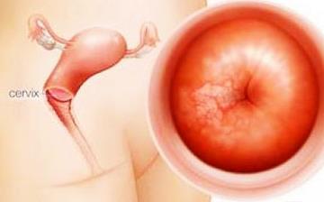 【宮頸松弛】宮頸松弛有哪些癥狀_宮頸松弛如何治療_宮頸松弛的原因 【宮頸松弛】宮頸松弛有哪些癥狀_宮頸松弛如何治療_宮頸松弛的原因