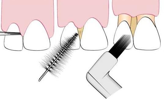 牙齦出血怎么回事？該如何預防牙齦出血