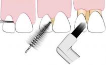 牙齦出血怎么回事？該如何預防牙齦出血