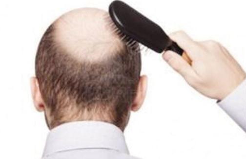 想要遠(yuǎn)離脫發(fā) 男人應(yīng)做持久戰(zhàn)