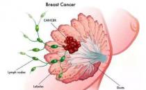 乳腺纖維瘤能不能治好？乳腺纖維瘤三級嚴重嗎