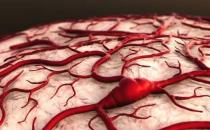 腦出血的前兆 這些事情應當注意