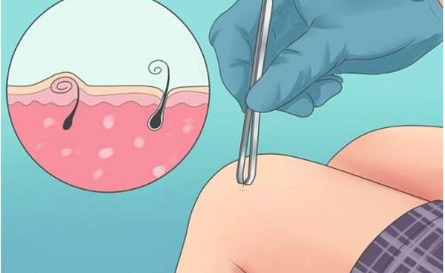 解決“毛發內生”的困擾 下面這7個方法可幫你