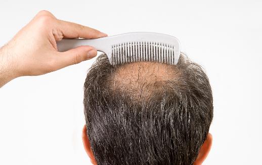 防脫治脫只靠洗護還不夠 頭發油膩的原因