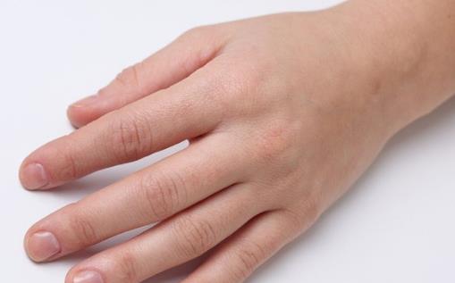 手上長水泡馬上去醫院 預防汗皰疹時的八大注意細