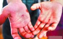 手上長水泡馬上去醫院 預防汗皰疹時的八大注意細