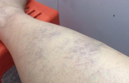 腿上莫名有淤青真是被鬼掐的嗎