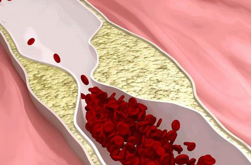 人到40歲血管易堵 吃什么可以清血管