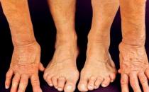 類風(fēng)濕越吃越健康的食物 類風(fēng)濕關(guān)節(jié)炎的飲食原則