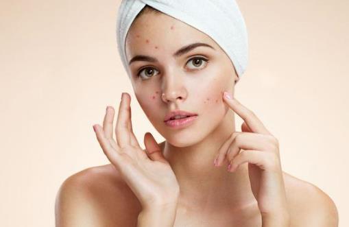 對祛痘有輔助作用的4類食物