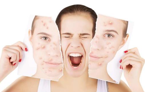 對祛痘有輔助作用的4類食物