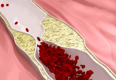 臉色發紅是不是血脂堵塞了血管?血脂過高的人會有什么表