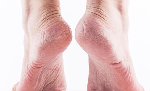 腳氣為什么偏愛(ài)夏天 治療腳氣有哪些偏方