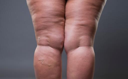 孕婦水腫怎么辦 多運動多休息