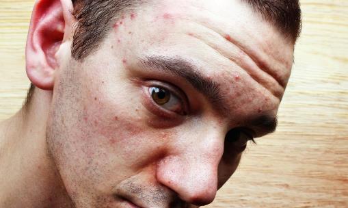 日常護(hù)膚避開(kāi)去粉刺的護(hù)膚誤區(qū) 去粉刺的方法大全