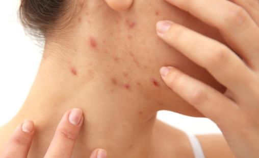 日常護(hù)膚避開(kāi)去粉刺的護(hù)膚誤區(qū) 去粉刺的方法大全