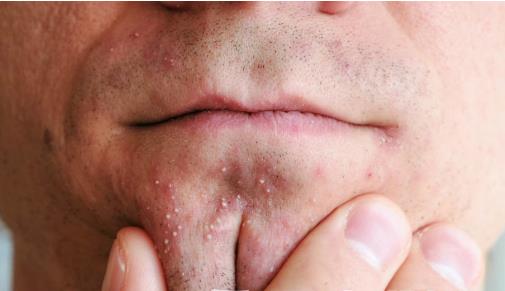 日常護(hù)膚避開(kāi)去粉刺的護(hù)膚誤區(qū) 去粉刺的方法大全