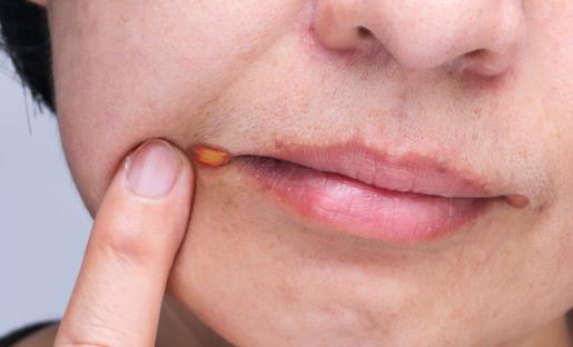 精神壓力大易導致口腔潰瘍 中醫偏方可治療口腔潰瘍