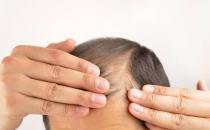 總使用電腦會導致脫發 預防脫發十秘訣擺脫脫發煩惱