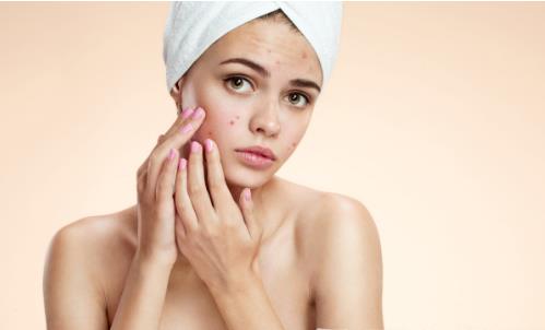 痘痘可以擠嗎 為什么會長痘痘