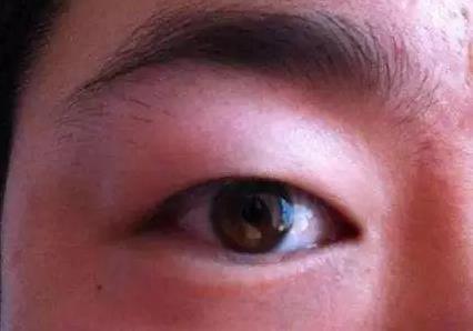 八大處整形楊欣:腫泡眼做雙眼皮手術應該注意什么?