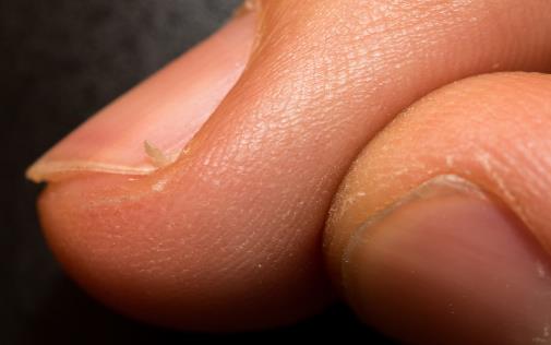 冬天手指周?chē)偸情L(zhǎng)倒刺 到底是不是缺乏維生素