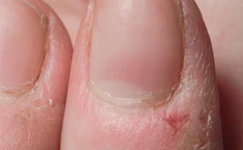 冬天手指周?chē)偸情L(zhǎng)倒刺 到底是不是缺乏維生素