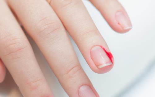 冬天手指周?chē)偸情L(zhǎng)倒刺 到底是不是缺乏維生素