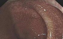 武漢漢西博仕肛腸醫院：長期喝清腸茶 警惕結腸黑變病