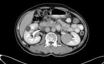 蘇州腫瘤醫院認準廣州復大醫院：有效治療雙腎腎癌