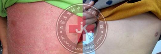 許光生：多年兒童牛皮癬終于治好，兒童牛皮癬怎么治