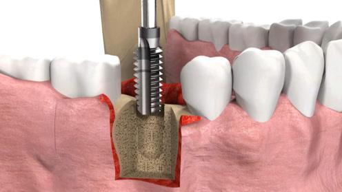 武漢做種植牙多少錢,種植牙品牌改如何選擇?