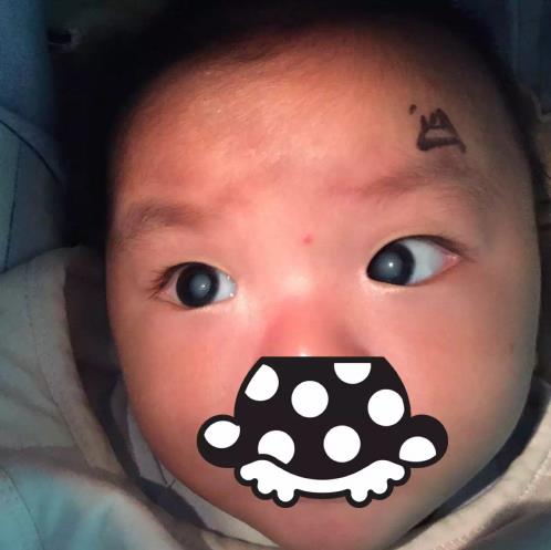 白內障手術打破年齡禁區