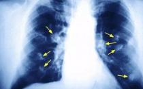 揪出引發女性肺癌的罪魁禍首 廚房油煙的危害超乎想象