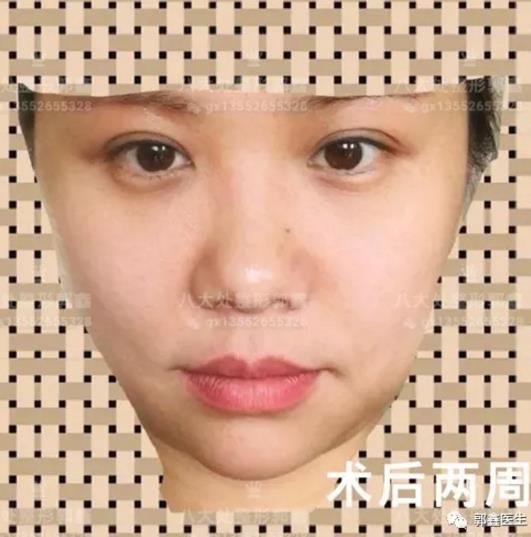 八大處整形郭鑫:眼部整形大約多少錢