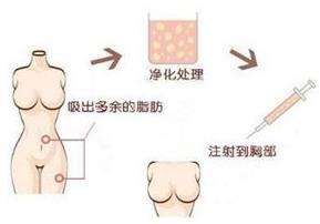 煤醫整形:自體脂肪豐胸的四大優勢